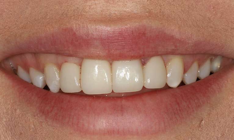 Porcelain-Veneers-After-Image