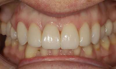 Smile Transformation After Clayfield