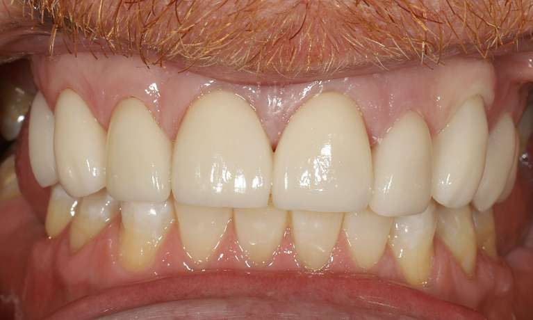 Porcelain-Veneers-Crowns-and-Teeth-Whitening-After-Image