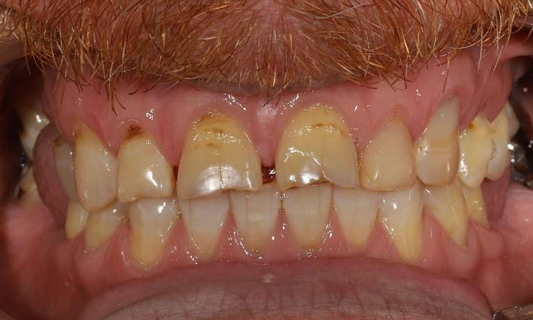 Porcelain-Veneers-Crowns-and-Teeth-Whitening-Before-Image