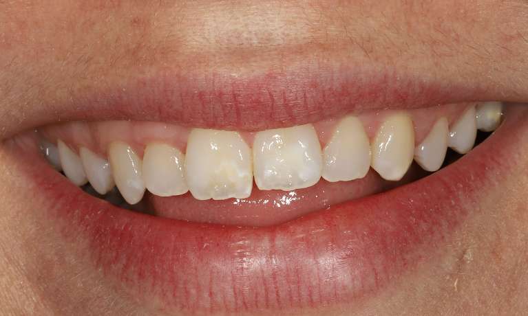 Porcelain-Veneers-Before-Image