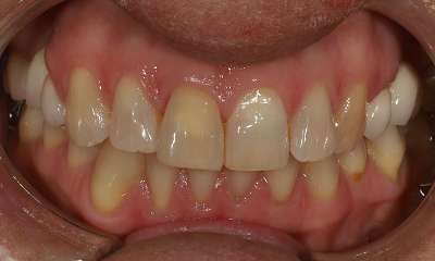 Smile Transformation Before Clayfield